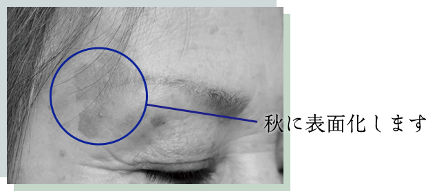 秋に表面化します