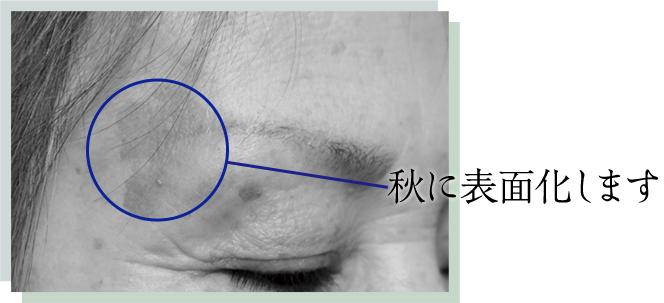 秋に表面化します
